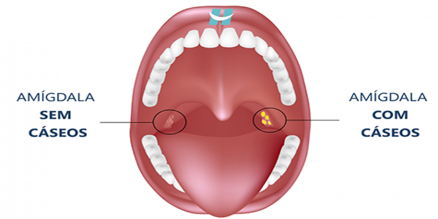 Cáseos amigdalianos: bolinhas malcheirosas que saem da garganta