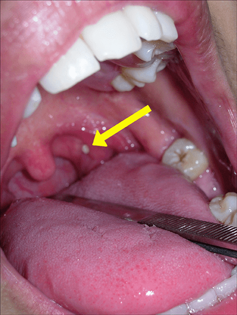 Caseum: conheça os sintomas das bolinhas na garganta