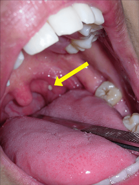 O que são bolinhas amarelas na garganta #caseum #amigdalitis