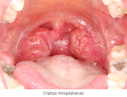 Cáseos amigdalianos Popularmente - Tarchiche Odontologia