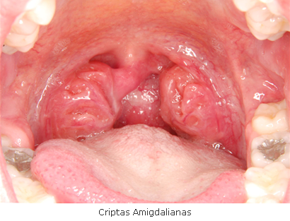 CÁSEOS AMIGDALIANOS: BOLINHAS MALCHEIROSAS QUE SAEM DA GARGANTA